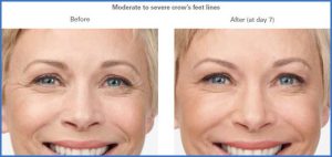 Botox Before and After photos