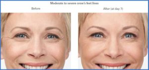 Botox Before and After photos