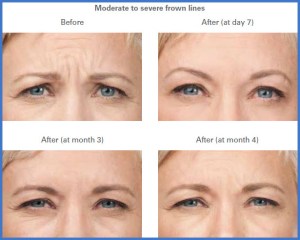Botox Before and After photos