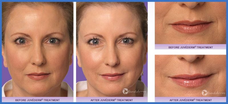 Before and after Juvederm treatment photos