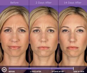 Botox before and after photos