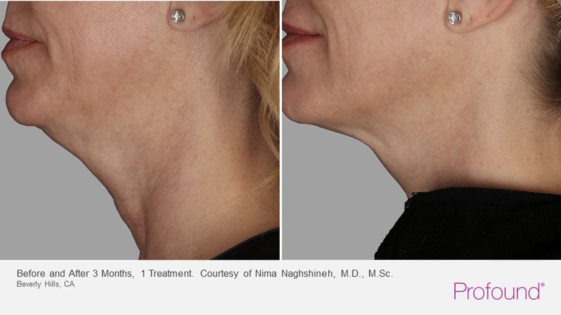 Before and After Profound Treatment, Image 1