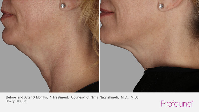 Profound Procedure Profound Facial Treatment Before & After Arlington, DC Metro